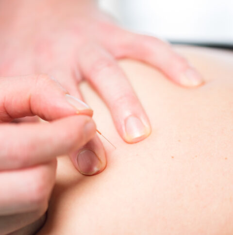 dry needling enschede polman